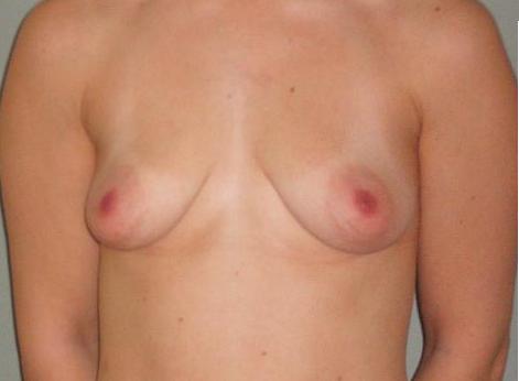 Breast correction with implants - before plastic surgery.
