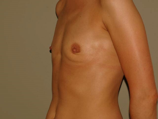 Breast enlargement - patient before Brava 3D method, view from the side.