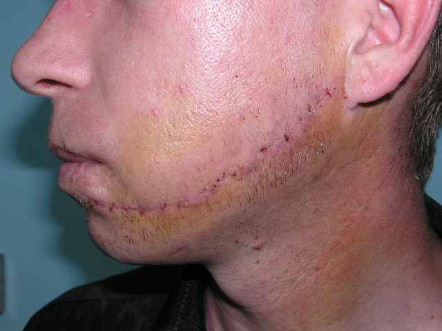After scar correction.